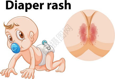 口水疹患有尿布疹的婴儿设计图片