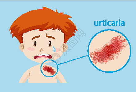 微美时代图表显示患有荨麻疹的男孩插画