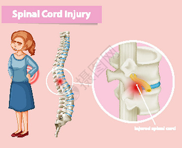 显示人类脊髓损伤的图表设计图片