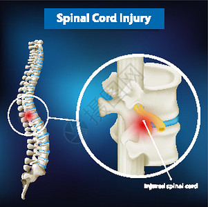 博斯凯奇显示脊髓损伤的图表海报科学生理解剖学艺术绘画插图病理疾病卡通片设计图片