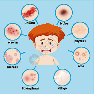 微美时代显示不同皮肤状况的男孩的图表插画