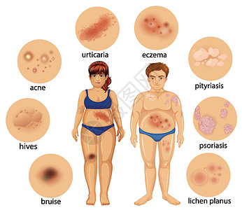 博隆福斯和沃斯显示不同皮肤病的图表插画