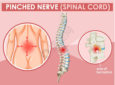 脊柱骨骼图表显示人类受压的神经男性病理绘画女性艺术微生物学男人女孩卫生生物学插画