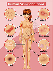 身体皮肤显示人体皮肤状况的图表粉刺卫生保健绘画身体女孩科学病理艺术女士插画