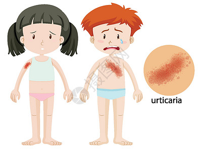微美时代图表显示患有荨麻疹的男孩和女孩插画