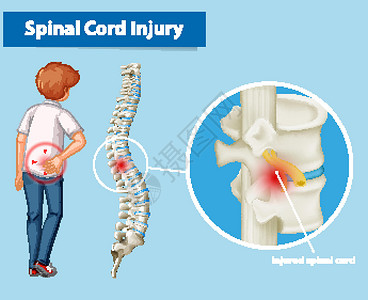 显示脊髓损伤的图表药品解剖学男人绘画夹子生理女性男性脊柱骨骼插画