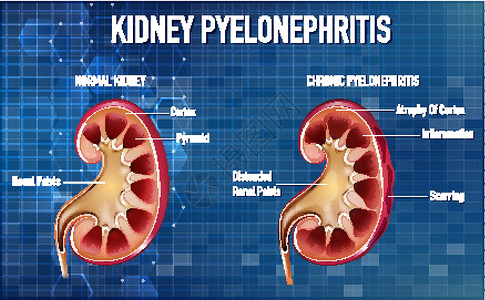 肾盂炎感染健康高清图片