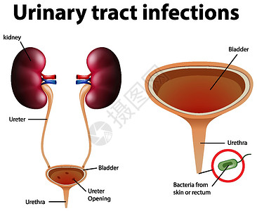 尿路感染的资料图症状学习图表解剖学生理细菌生物学器官输尿管身体插画
