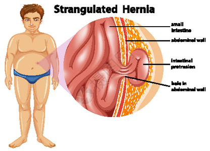 腹壁男人绞窄性疝气设计图片