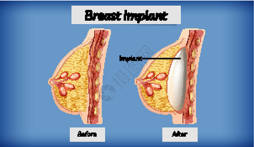 人体乳房植入物的解剖绘画女性胸部意义外科卡通片男性艺术女孩夹子背景图片