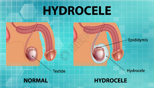 显示男性正常睾丸和鞘膜积液之间差异的医学海报疾病信息症状图表插图附睾疼痛药品卡通片男人插画