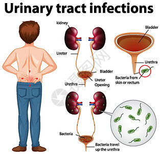尿路感染的资料图解剖学学习感染症状刀片疼痛微生物学插图教育器官图片