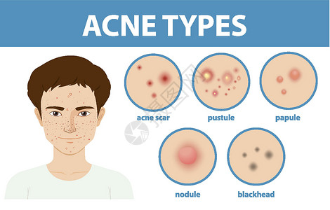 脓疱皮肤上的粉刺或粉刺类型框架黑头插图毛孔护理卡通片空白指示牌瘢痕疾病插画