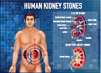 肾结石资料图生理膀胱药品图表男性病理解剖学学习医疗意义背景图片
