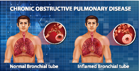 慢性阻塞性肺病病理x光支气管器官管子生理信息解剖学疾病药品背景图片