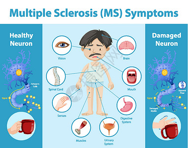 多发性硬化症 MS 症状信息 infographi神经元框架身体指示牌脊柱病人绘画插图脊髓骨骼插画