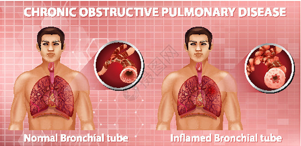 慢性阻塞性肺疾病慢性阻塞性肺病科学病理药品管子学习器官生物学疾病信息生理设计图片