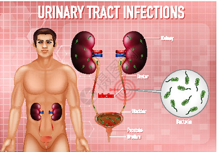 尿路感染的资料图绘画海报输尿管教育图表学习尿道刀片科学药品插画