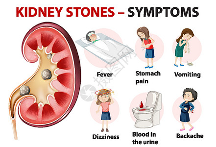 肾结石症状卡通风格 infographi病人卡通片医生教育发烧插图血尿学习图表疼痛背景图片
