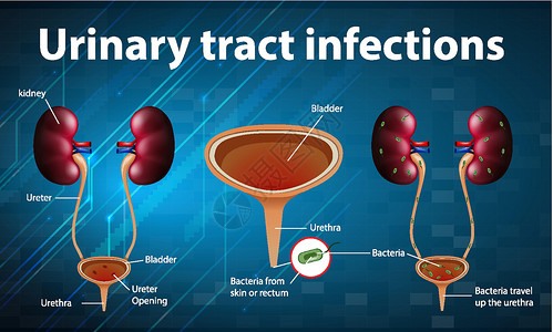 尿路感染的资料图药品科学绘画图表教育病理生物学学习海报插图插画
