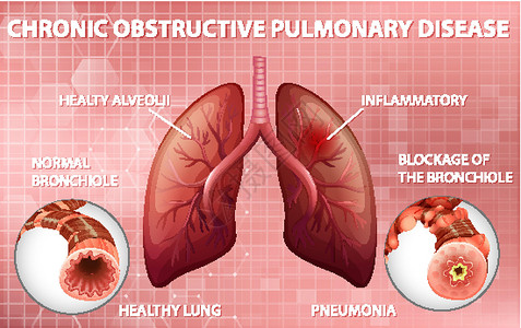 慢性阻塞性肺疾病慢性阻塞性肺病生理教育解剖学科学微生物学生物学管子药品图表疾病设计图片
