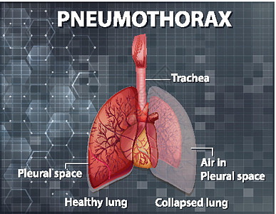 气胸的资料图教育科学绘画气体感染空气肺泡微生物学生物学图表背景图片