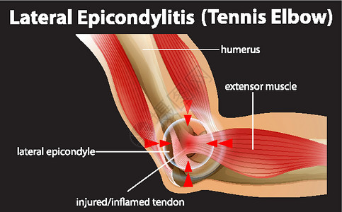 右外侧直肌外侧上髁炎或网球肘运动病人疾病框架整脊神经学习生物教育科学插画