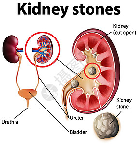 肾结石资料图插图绘画信息生物学图表膀胱生理意义教育艺术背景图片