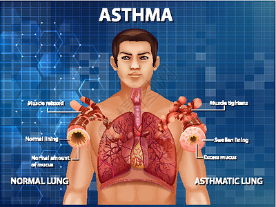 人体解剖学哮喘图器官病理哮喘解剖学插图生物学信息绘画微生物学教育背景图片