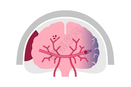 脑出血人类脑中中风病媒说明类型动脉静脉疼痛图表脑血管疾病脑梗塞攻击信息科学插画