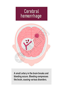 人类脑中中风病媒说明类型 脑出血图表药品动脉粥样硬化疾病血管解剖学大脑压力警告船只插画