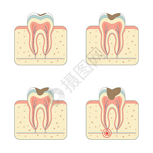 蛀牙病牙疼牙周解剖学疾病脓肿搪瓷运河牙齿疼痛牙科设计图片