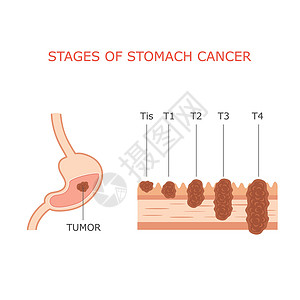 胃癌分期背景图片