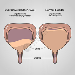 尿道过度活跃和正常的膀胱 泌尿系统疾病插画