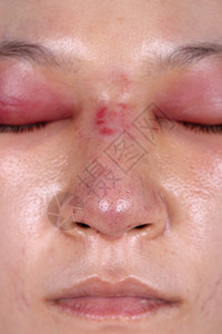 鼻子手术后眼睛肿胀皮肤工作蓝色成人医生塑料女性状况伤口药品背景图片
