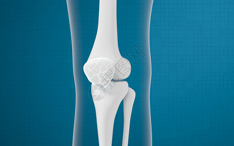 腿骨和膝盖 3D感应胫骨治疗手术插图骨骼渲染关节身体软骨疼痛背景图片