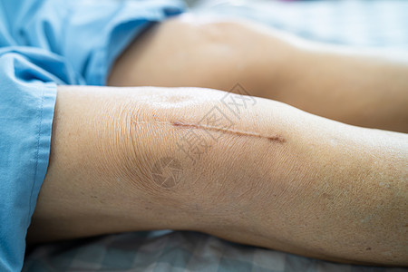 术后疤痕亚洲老年或老年老太太妇女病人在护理医院病房的床上展示她的疤痕手术全膝关节置换缝合伤口手术关节成形术 健康强大的医疗理念女性药品切背景
