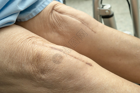 切口亚洲老年或老年老太太妇女病人在护理医院病房的床上展示她的疤痕手术全膝关节置换缝合伤口手术关节成形术 健康强大的医疗理念肌腱危险替背景