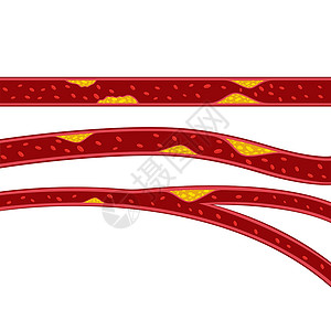 动脉硬化胆固醇斑块它制作图案的载体营养高血压插图攻击血小板标识安全动脉糖尿病水果插画