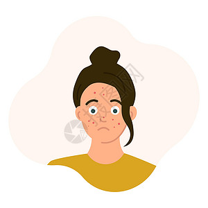 青少年心理问题悲伤的少女脸上长着青春痘过渡期问题皮疹 在白色背景上隔离的平面样式中的矢量插图设计图片