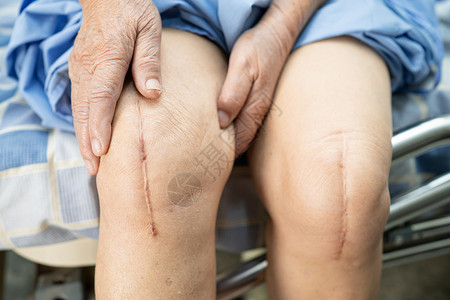 热敷护膝盖亚洲老年或老年老太太妇女病人在护理医院病房的床上展示她的疤痕手术全膝关节置换缝合伤口手术关节成形术 健康强大的医疗理念纤维皮肤护背景