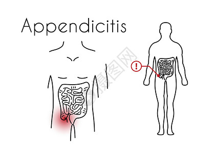 腹膜炎年轻马的矢量阑尾炎线性图标插画