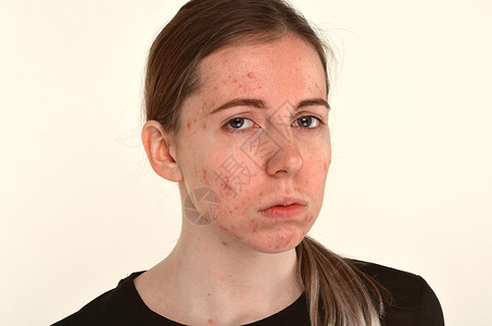 脓疱皮肤有问题 阴孔问题概念的年轻美少女治疗化妆品青少年疾病黑头面具皮肤科女士女孩女性背景