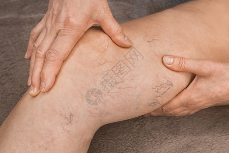 小腿静脉一位年长女性的手在变动血管上展示 生病的女性双腿皮肤身体痛苦静脉病人浮肿肿胀蜘蛛血栓外科背景