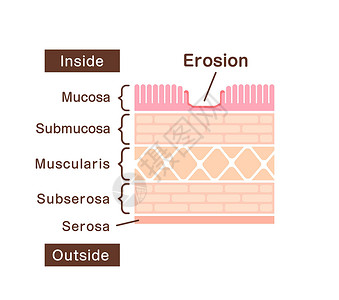 幽门螺旋杆菌感染胃侵蚀的剖面图解说明图表风险疾病感染横截面疼痛外科肿瘤身体诊断设计图片