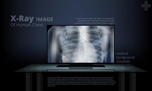全国计算机等级考试计算机屏幕上的X光人类胸透图像设计图片