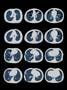 纤维化Covid-19 计算肺部地形图 CT扫描设计图片