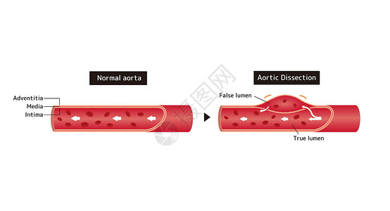 夹层正常动脉和张动脉解剖的比较说明设计图片