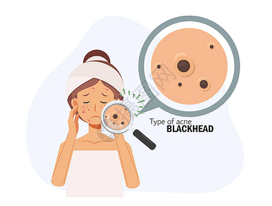 黑头发治疗痤疮 皮肤问题 疙瘩 女人的脸 痤疮黑头的类型 平面矢量 2d 卡通人物插图 之前 之后设计图片