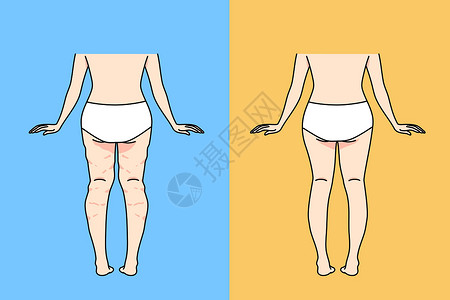 在切除纤维素后穿内裤的妇女设计图片